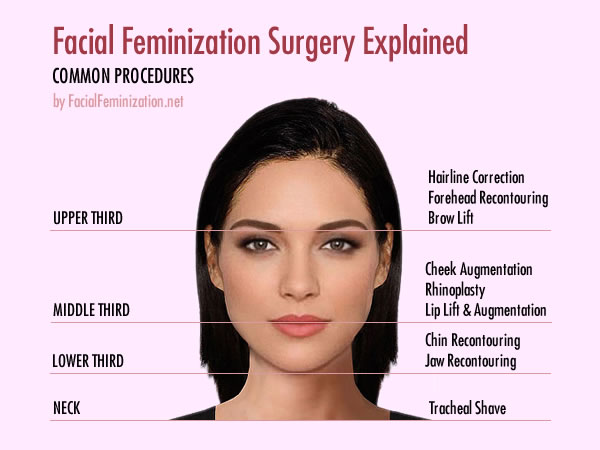 Facial Feminization Surgery Explained
