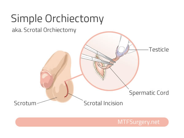 Simple Orchiectomy for Trans Women