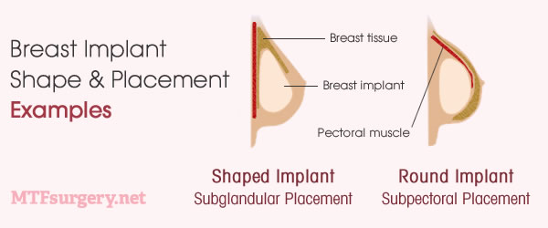 MTF breast implants - shape and placement